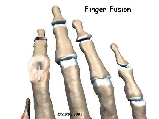 can be repaired surgically, or the joint can be fixed in place. A surgical pin acts like an internal cast to keep the DIP joint from moving so the tendon can heal.