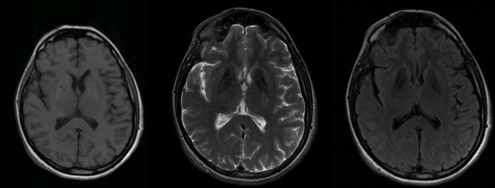 Brain MRI Scan Axial