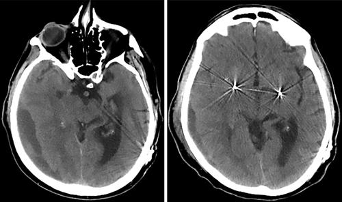 T. Chen et al. FIG. 1. Left: Axial CT scan obtained on ostoerative Day 14, demonstrating increased size of right arietal subdural hematoma with mass effect.