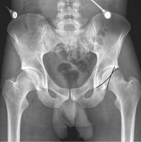 In this investigation of a population of 1417 hips with varying degree of retroversion, a positive PWS was present in 419 (31%) and a positive PRISS in 833 (61.7%) of the cases.