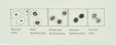 Dyskaryosis