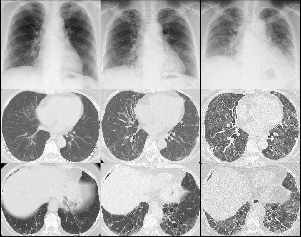 E588 Murata et al. Periostin accumulation in acute exacerbation of IPF A B C Figure 1 Chest radiographs and computed tomography images showed symmetrical reticular and ground glass opacities.