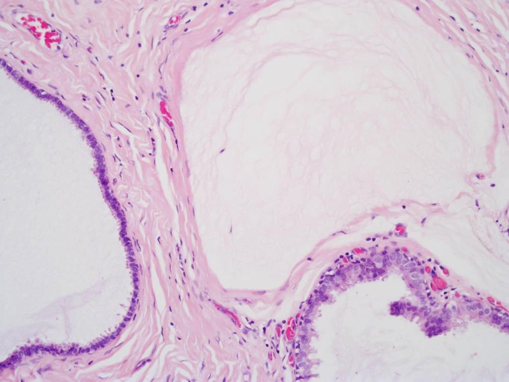 The epithelium in these mucocele-like lesions is typically variable.