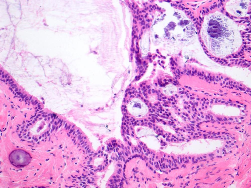 Here is an example of one of the hyperplastic lesions we see in mucocele-like lesions. You see the calcifications on the upper right.