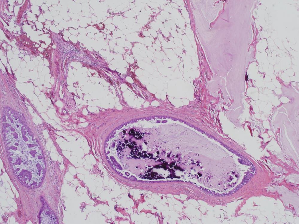 Here is a case of ductal carcinoma in situ, which is associated with a mucocele-like lesion, at least with extravasated mucin.