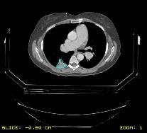 Internal Organ Motion Control (as defined in RTOG #0236) Acceptable maneuvers include reliable abdominal compression, accelerator beam gating with the respiratory cycle, tumor tracking, and active