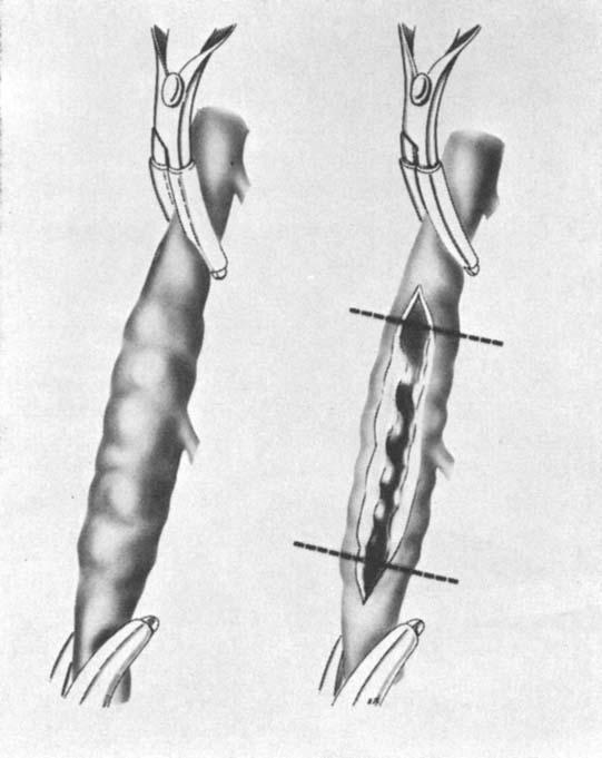 Vein Autograft for Coronary Occlusion FIG. 1. On the left, the coronary artery is shown dissected and clamped.
