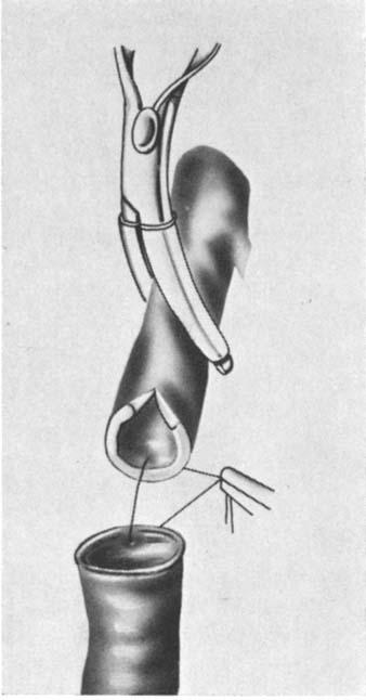 FAVALORO FZG. 2. The first suture is being placed posteriorly; the saphenous vein is approximated and the suture is tied. FIG. 3. The proximal anastomosis.
