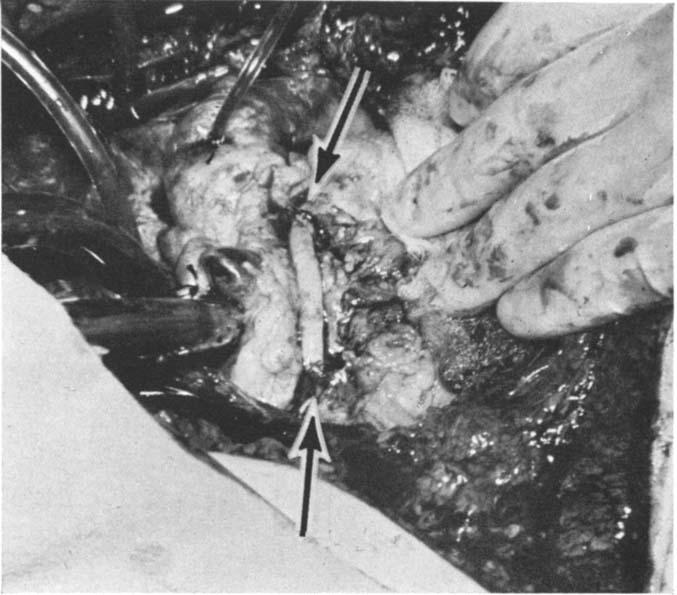 Vein Autograft for Coronary Occlusion FIG. 4. Saphenous vein autograft at the end of the procedure.