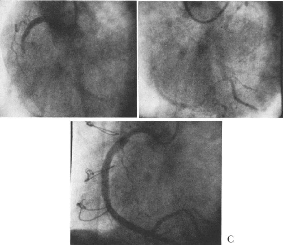 FAVALORO FIG. 5. Coronary angiogram of a 55-year-old Caucasian woman with total occlusion of the right coronary artery (A).