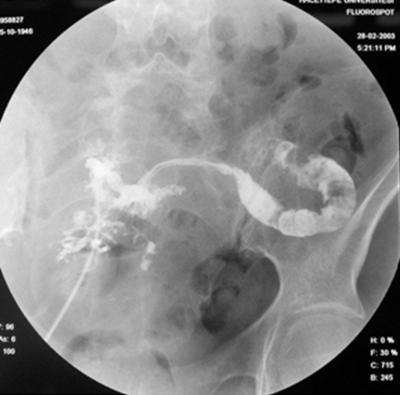 Figure 2 Figure 2: Distribution of the radioopaque contrast agent, injected through the catheterized orifices is compatable with small bowel segments Figure 3 Figure 3: Conglomerated bowel segments,
