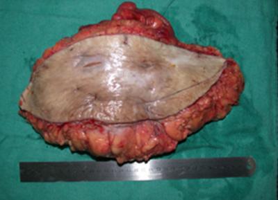 incisions encircling the abdominal skin from where the orifices of the fistula drain, the small bowel segments from 170 to 270 cm after the Trietz ligament were found to conglomerate within the