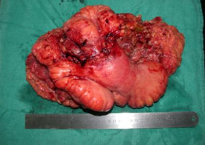 The dissection of the bowel segments wither from the hernia sac or from each other would further contaminate the surgical area, therefore conglomerated bowel segments, hernia sac and all orifices of