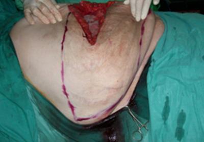 Figure 5 Figure 4: a) Planned incisions for removal of excess skin and subcutaneous fat to prevent the development of Â dog earsâ after closure of the wound and to resect bulging pendulous anterior