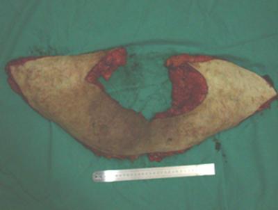 Figure 6 The first resected specimen including the abdominal wall and small bowel segments was measured to be 2550 gr while the second specimen obtained for abdominal contour correction was measured