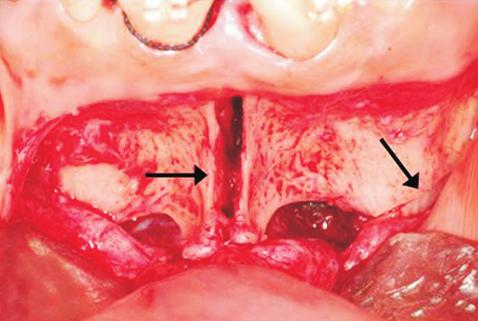 bilaterally, extrusion of the left upper first molar, and a narrow maxillary arch with crowded incisors.(fig. 2.