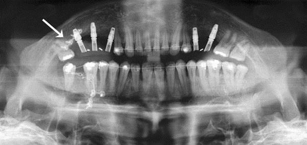 Stability of unilateral sagittal split ramus osteotomy for correction of facial asymmetry on the mandible for its rotated setback on the left side.