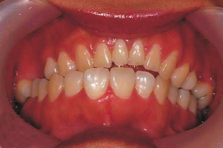 Intraoral preoperative photography reveals unilateral posterior crossbite on the left side, missing right lower posterior teeth, and extrusion of the opposing upper teeth.