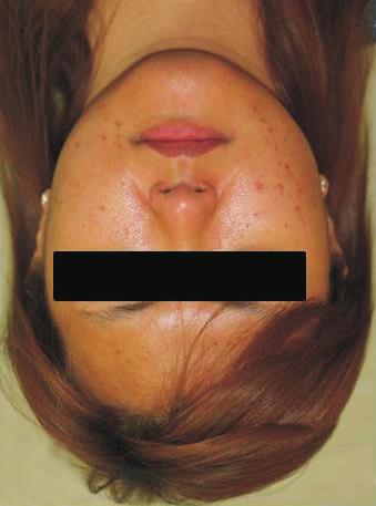 patient achieved facial symmetry and stable occlusion.