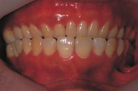 right mandible. She showed symmetrical facial morphology and stable occlusion after 18 months of postoperative orthodontic treatment.(fig. 4.
