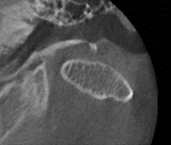Stability of unilateral sagittal split ramus osteotomy for correction of facial asymmetry Coronal Sagittal Axial Case 3 Case 2 Fig. 5.