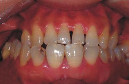 extrusion of opposing teeth. D-F.