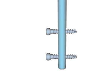 5mm Driving End of Nail (Proximal Lock) 30mm