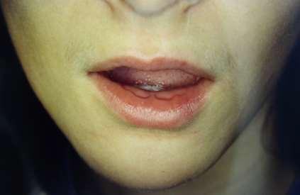 Angle II./1 Upper incisors lean on the lower lip Incomplet lip closure Hyperactivity of the musc.