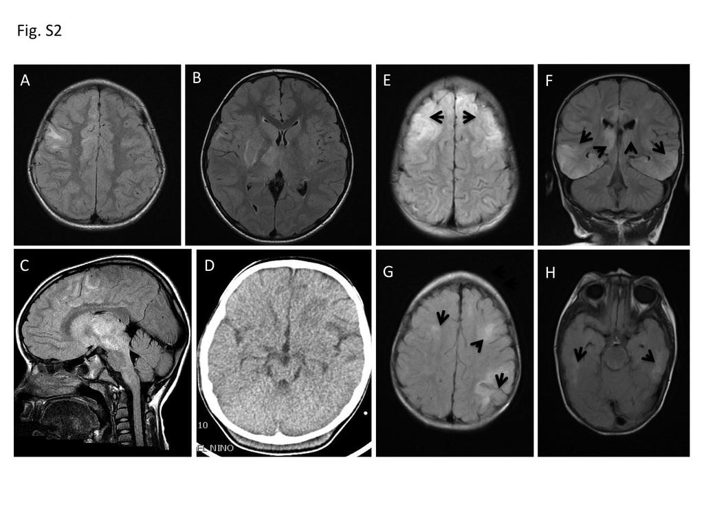 Figure S2. Radiologic findings from Panamanian patients suffering from EEE. A-C, patient 247134. A. Axial T2-weighted images and FLAIR shows increased signal intensity at the frontotemporal cortical/subcortical level; B.