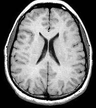 posterolateral portion of the thalamus does not count towards total lesion count