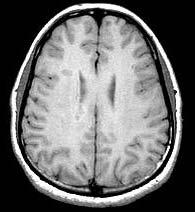 cortical grey ribbon D E F Figure 4: Multiple axial slices of a T1-weighted image