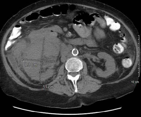 CT Abdomen & Pelvis 1. Marked abnormal appearance of the right kidney with neoplasm favored over subacute trauma or inflammatory disorder. 2.
