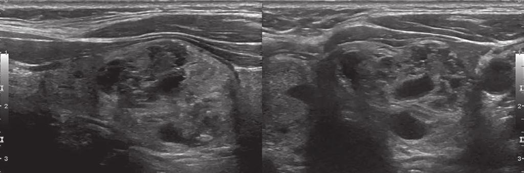 Zhu et al. Fig. 1 59-year-old woman with complex nodule in left thyroid lobe. A, Sagittal (left) and transverse (right) gray-scale ultrasound images show 3.