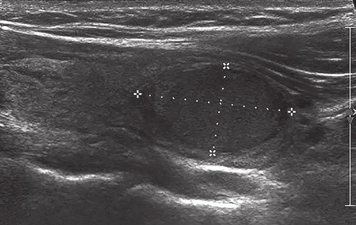 Zhu et al. A B Fig. 2 27-year-old woman with solid nodule in right thyroid lobe. A, Sagittal gray-scale ultrasound image shows 2.