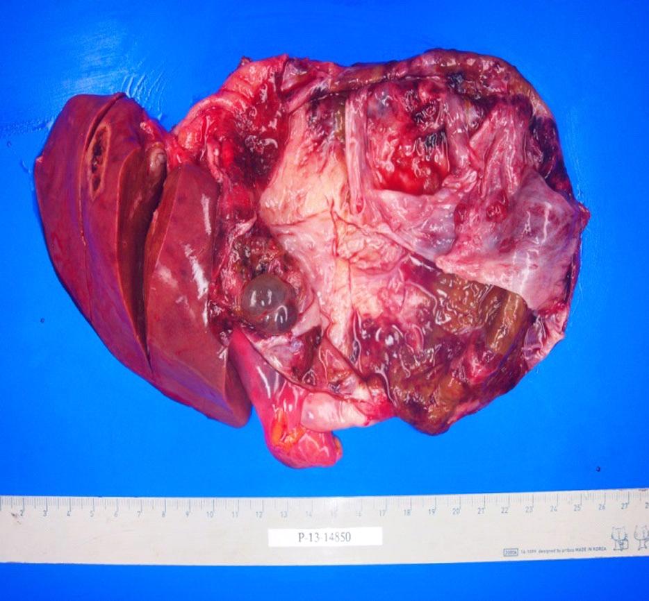 Fig. 3. Postoperative picture shows large thick walled cystic lesion in left lobe of liver. presence or absence of mesenchymal stroma, ovarian stroma.
