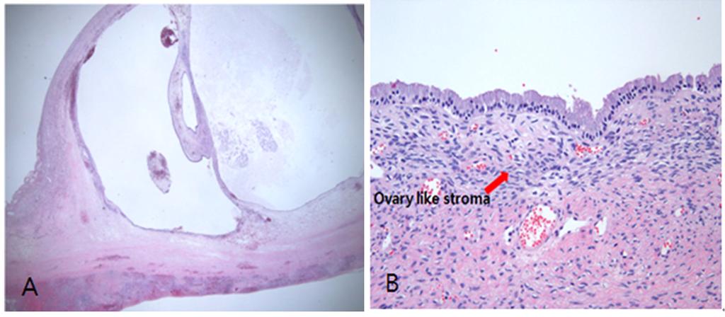 Incidentally Found Biliary Cystadenoma Fig. 4. Cyst histology typical of a mucinous cystadenoma(a) Biliary cyst shows ovary like stroma (H &E stain,x400). (B) Arrow demonstrating ovary like stroma.