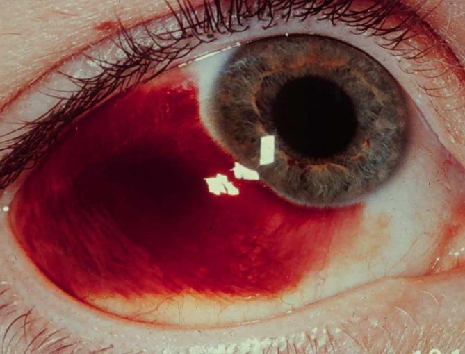 Hyphema Retinal detachment Retinal hemorrhages Globe rupture Eyelid