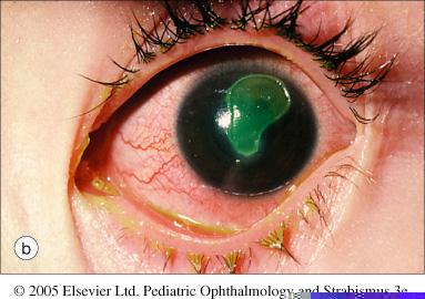 prescribe to patient fluorescein staining of the cornea (yelloworange dye, appears green with cobal blue light) Corneal abrasion