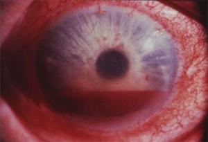 Consult ophthalmology if near central cornea or if