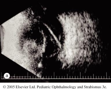 Retinal detachment Ultrasound