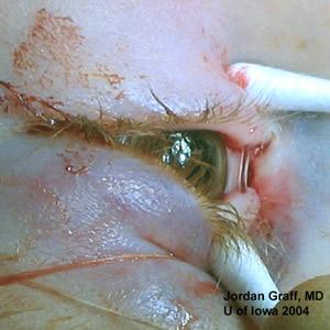 placement Corneal 