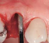 socket or ridge augmentation or preservation, which may include the use of particulate autografts, allografts, alloplasts, xenografts, and membranes manufactured from various materials, including