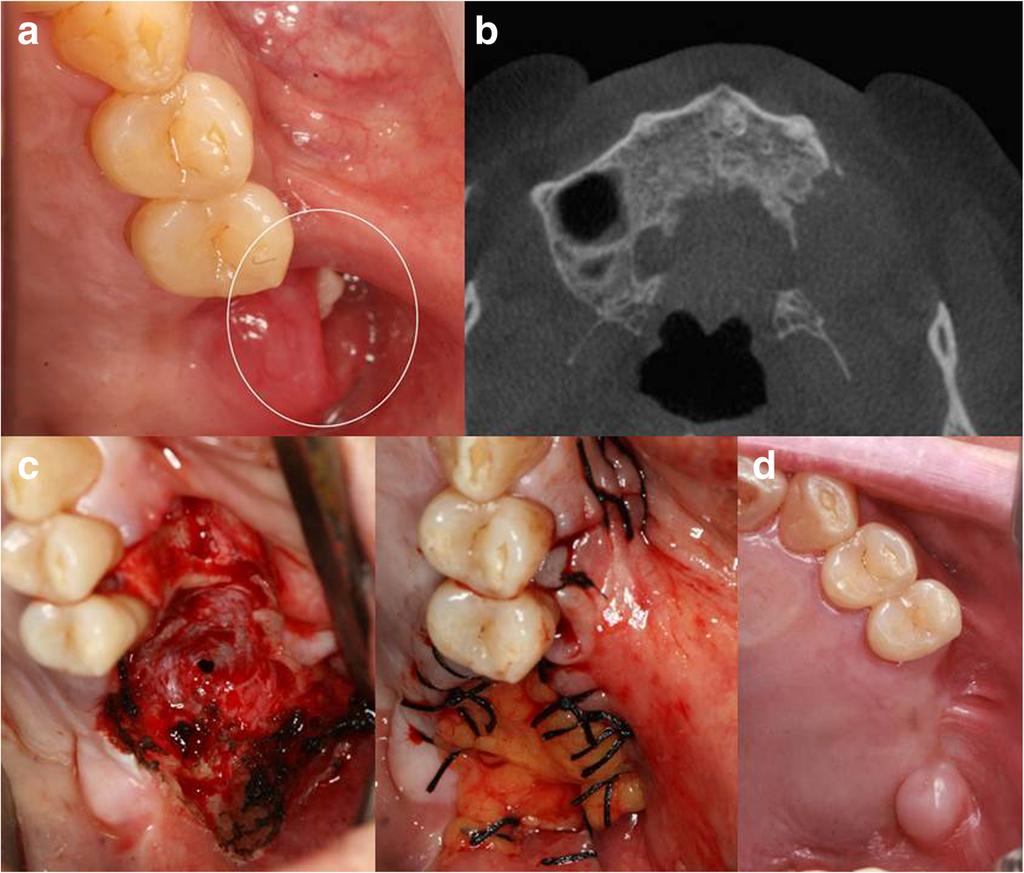 d After 3 months, the operation site was successfully closed and well healed (Fig. 3a). A CT scan showed alveolar bone destruction and an ameloblastoma lesion (Fig. 3b).
