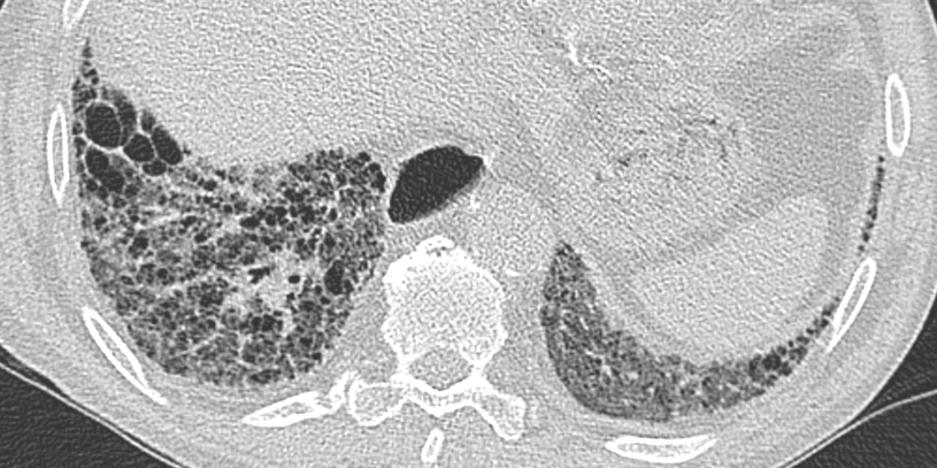 Pulmonary fibrosis in a patient with scleroderma. Multiple variable sized cysts are seen.