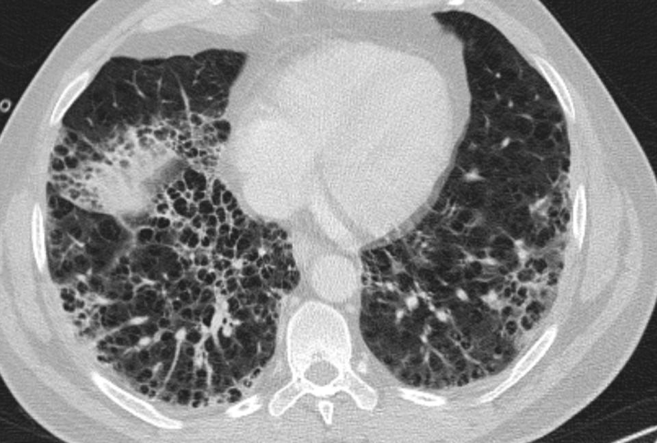 Centrilobular emphysema under other pulmonary conditions Infection, inflammatory