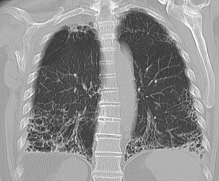 Introduction Diagnosis of radiological honeycombing is crucial for establishing an usual interstitial pneumonia pattern, for that reason a confident diagnosis is desirable.