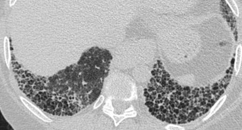 There is a typical appearance (figures) of clustered peripheral thick wall air cysts that cause few problems for the vast majority of readers, but the daily radiological spectrum can be more