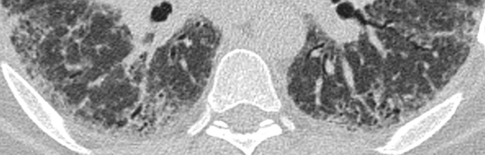 Small cysts Radiologists must be aware that a microscopic honeycombing under CT scans resolution frequently exists.