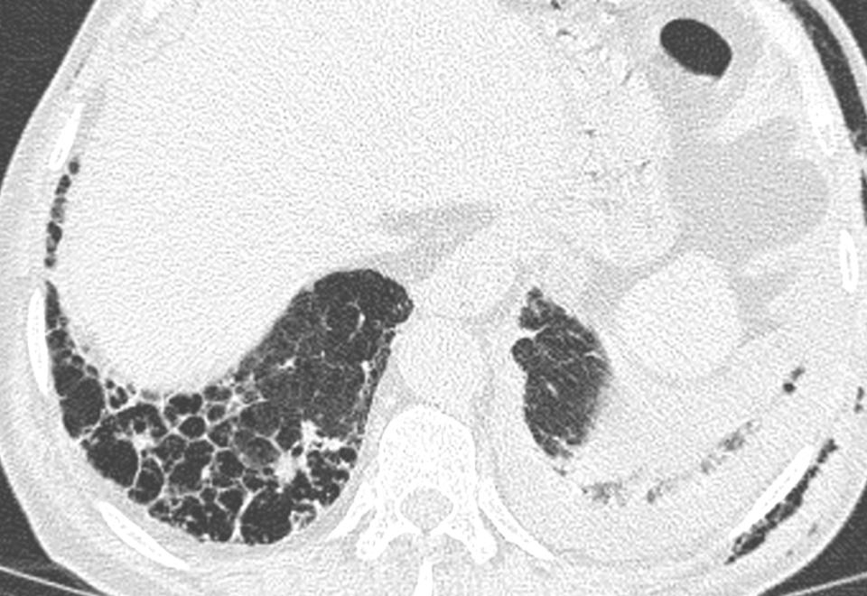 Big cysts Honeycombing in areas with emphysema and fibrosis can be difficult to differentiate from each other 64-year-old smoker with rheumatoid