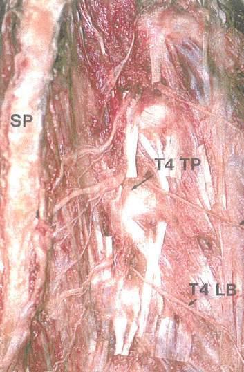 T1-T4 Medial Branches Spinous Process T2 Medial Branch Cadaver dissections show that the T1-T4 medial branches cross the